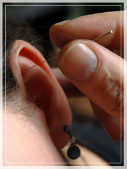 Auricular Acupuncture