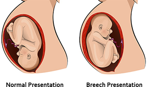 Breech position