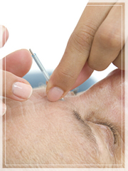 Acupuncture for Ansiety