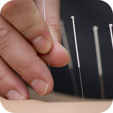 Acupuncture